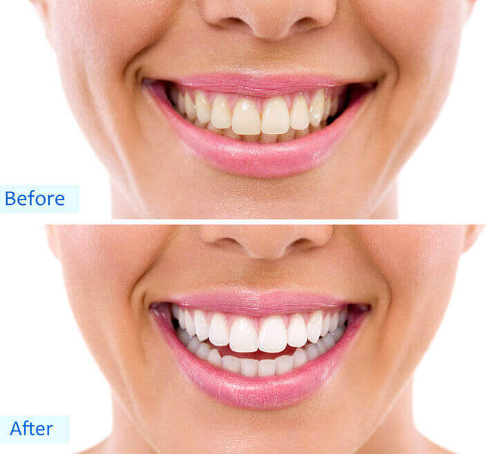 Tooth Whitening Toronto