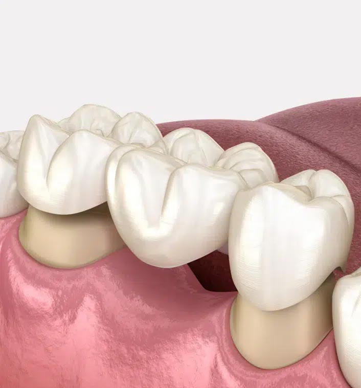 Dental Bridge