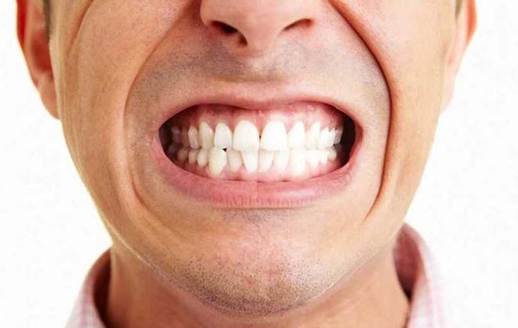 Bruxism