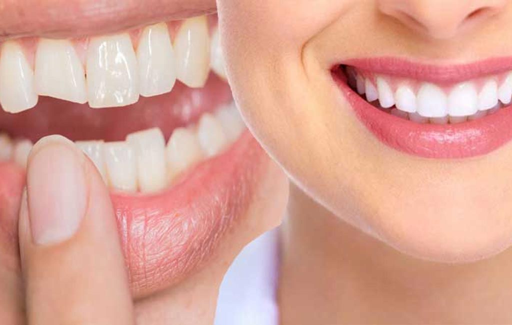 Dental Bonding