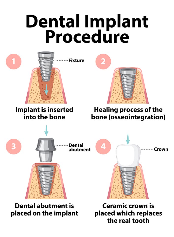 Dental Implant Procedure
