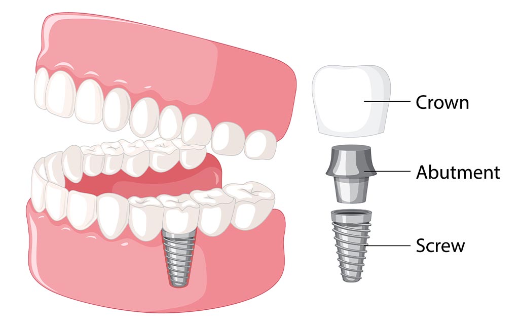 Dental Implants