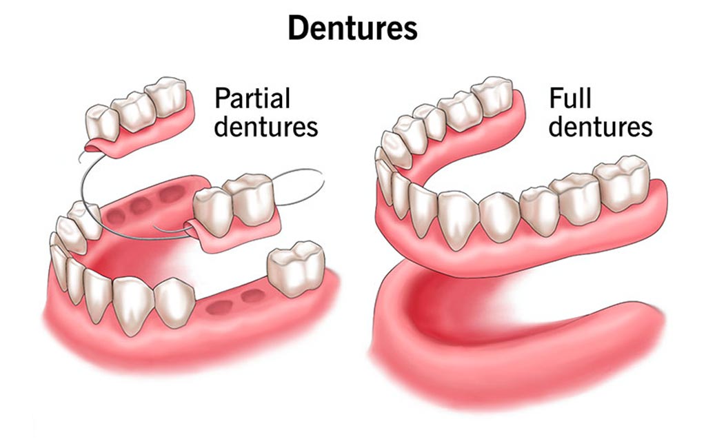 Types of Dentures