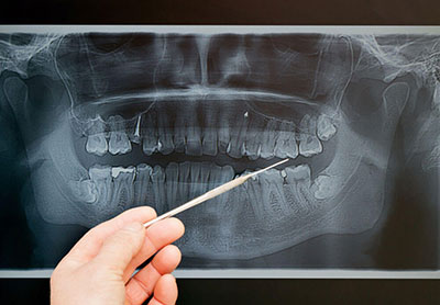 Digital X-rays