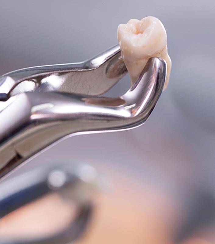 Dental Extraction