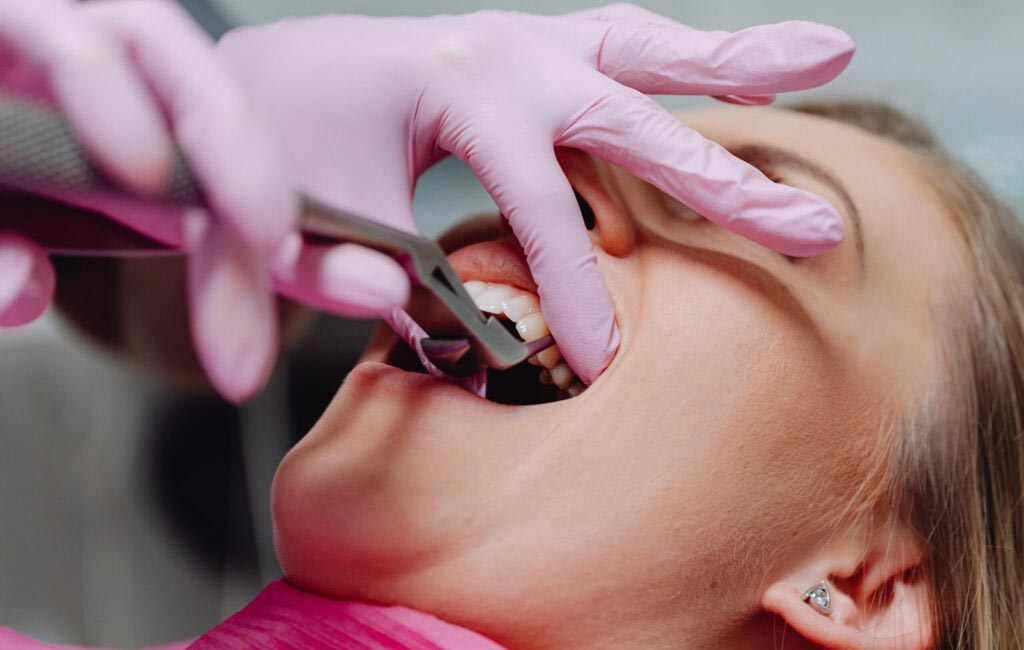 Dental Extractions