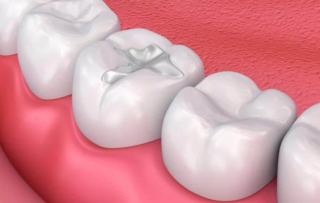Dental Filling