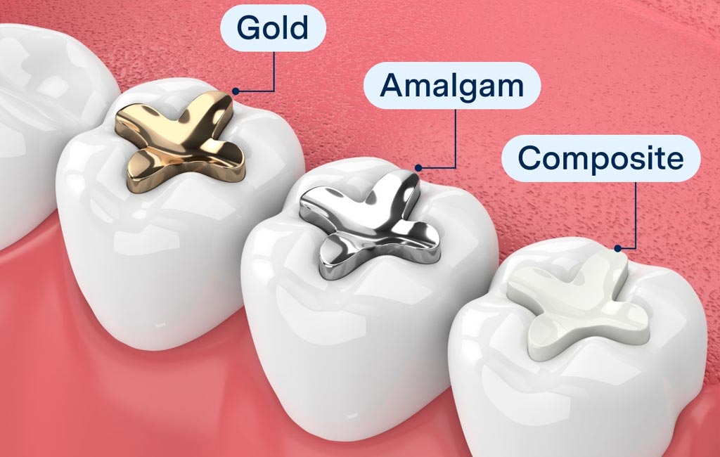 Types of Dental Filling