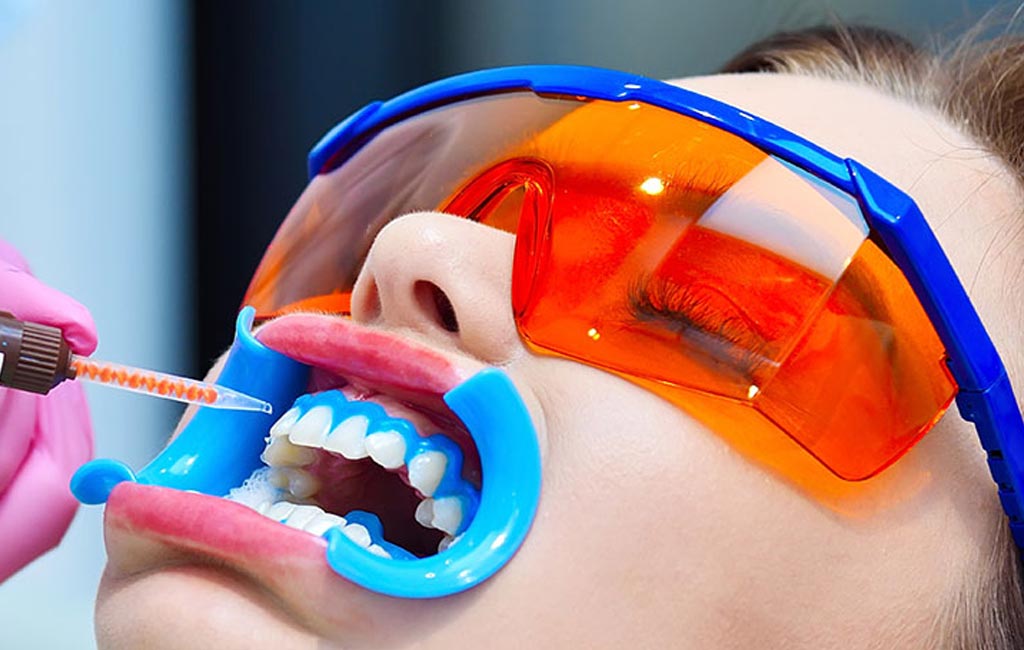teeth whitening