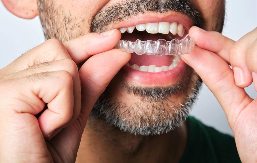 Invisalign