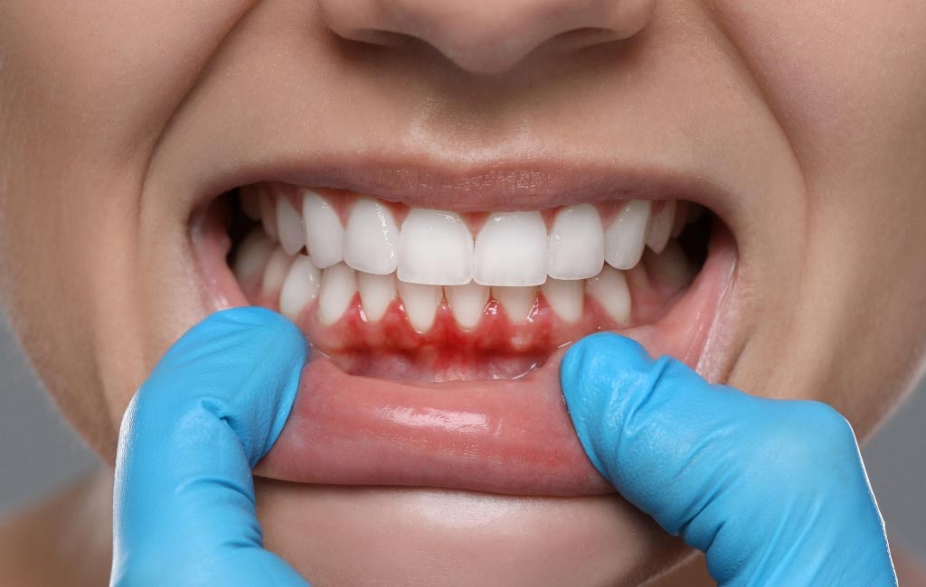 Periodontal disease