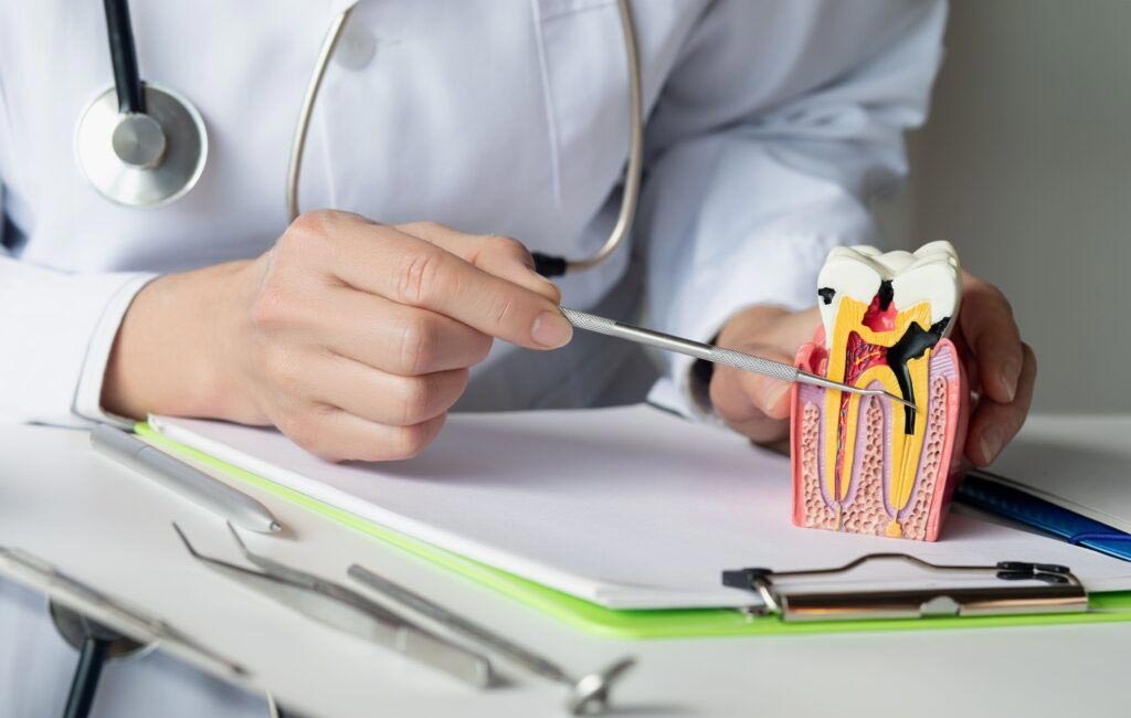Root Canal