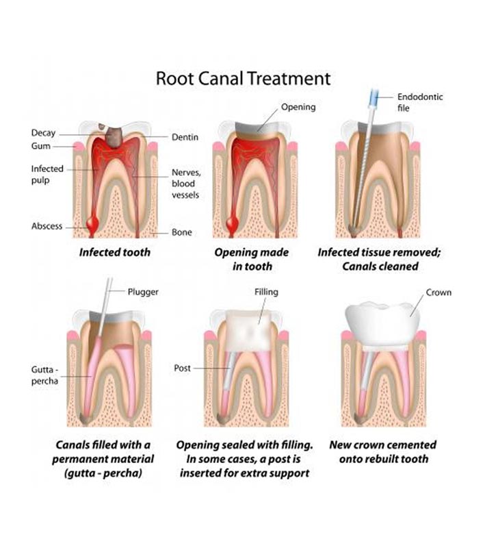 Root Canal Treatment