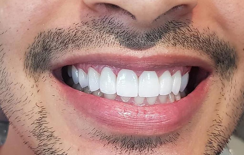 Veneers